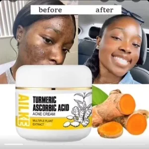 Acne Cream
